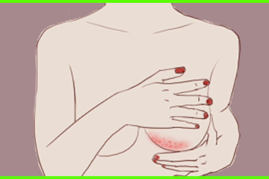 11 House Treatments To Get Rid Of Rashes Below The Breast