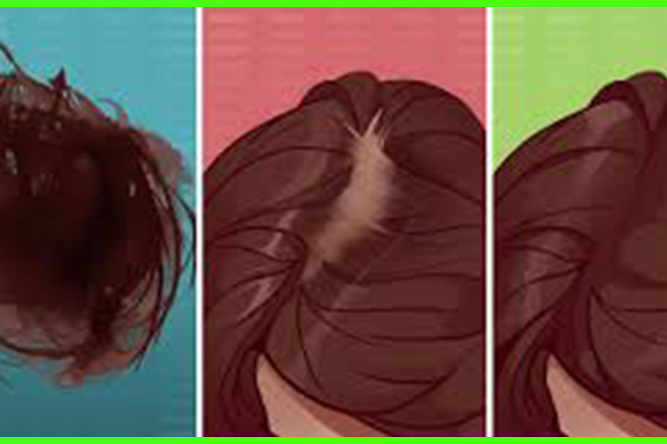 6 Varieties Of Hair Fall – Causes, How To Diagnose, & Therapies