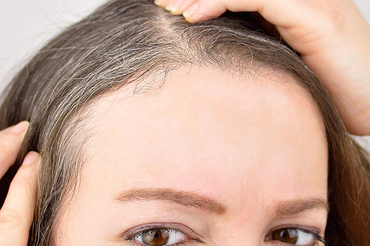 What Is Poliosis? Causes And Remedy